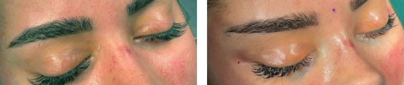 Schläfenlifting Temporal Lifting Vorher-Nachher Bilder