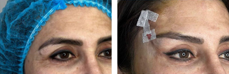 Temporal Lifting Vorher-Nachher Bilder