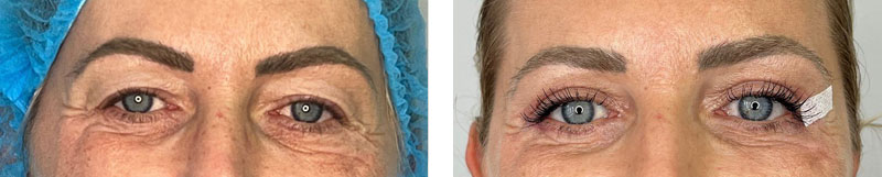 Augenlidstraffung vorher nachher Augenlidstraffung Vorher Nachher