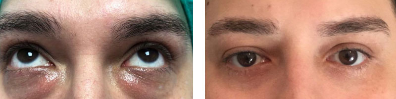 Unterlidstraffung vorher nachher Unterlidstraffung Vorher-Nachher Bilder