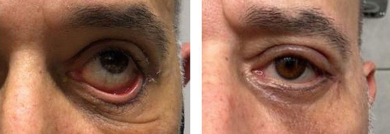 Unterlidstraffung vorher nachher Unterlidstraffung vorher nachher