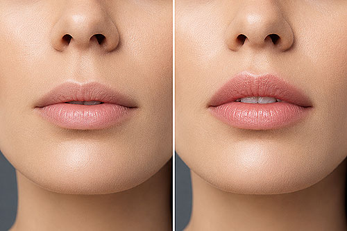 Lip lift bullhorn lift_mannheim heilbronn aplus Lip lift bullhorn lift_mannheim heilbronn aplus